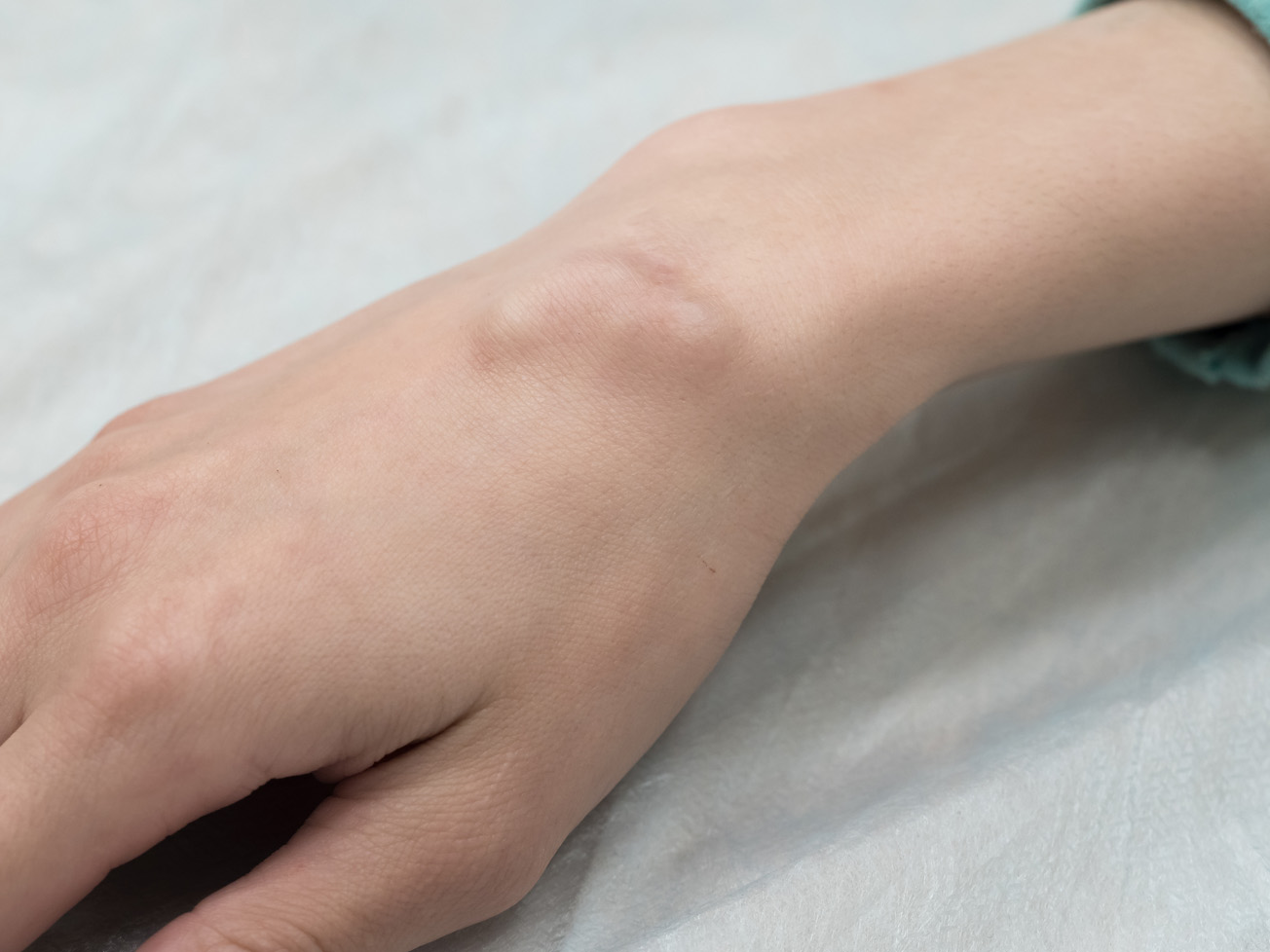 Ganglion cyst on the top of the wrist