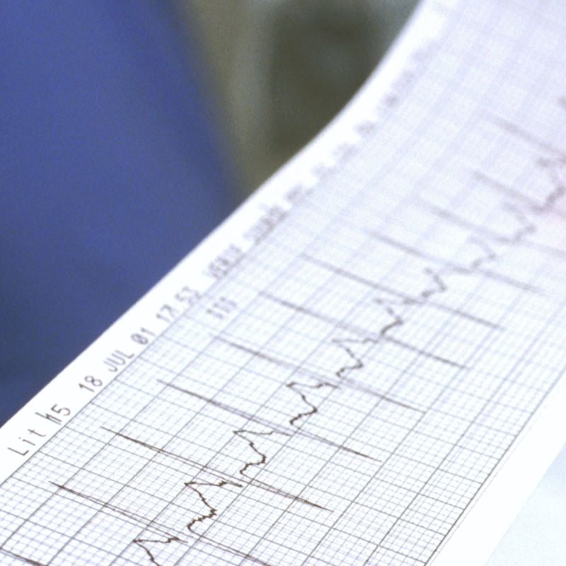 A health care provider is reviewing an EKG