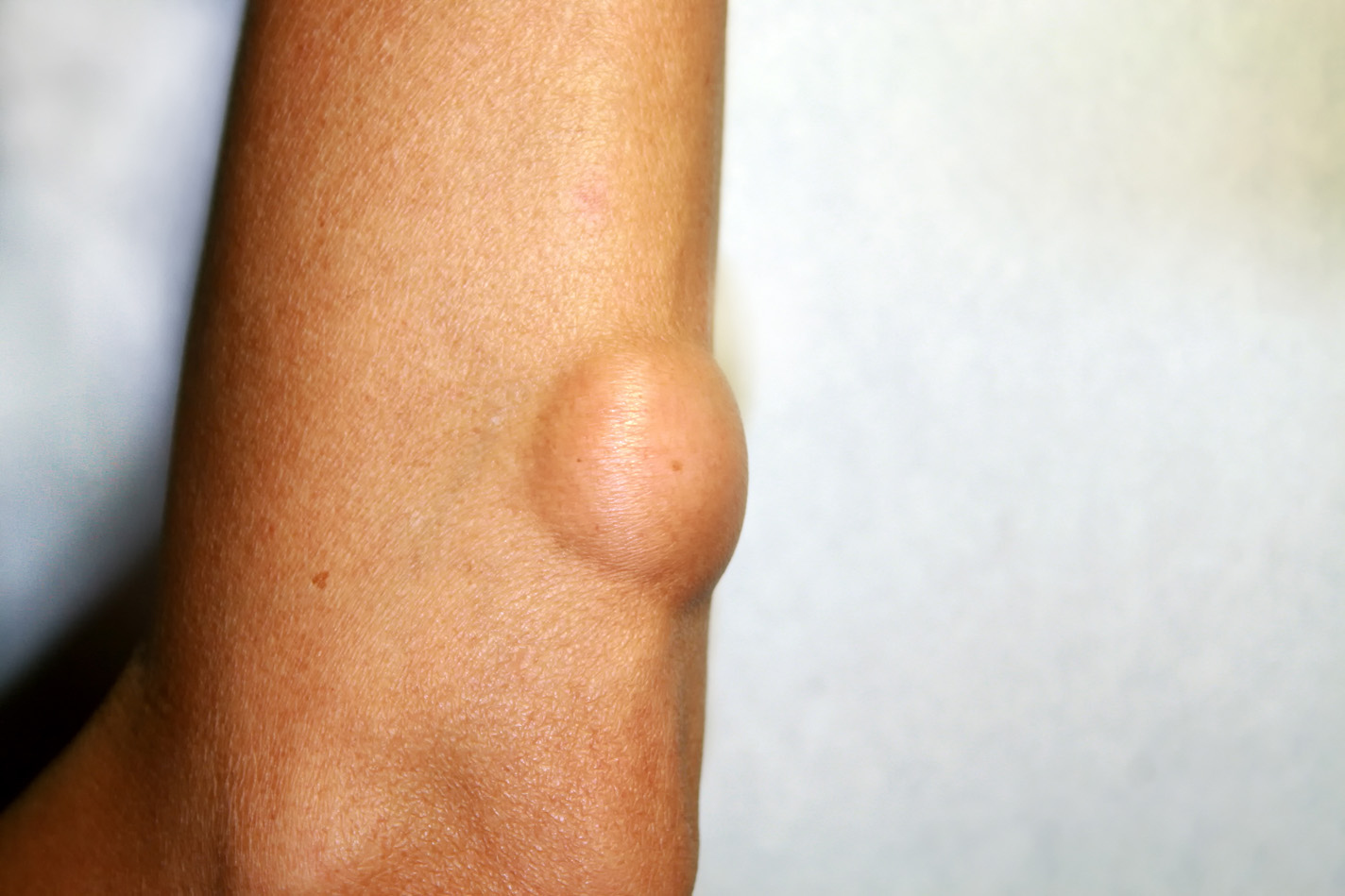 Benign Forarm Lipoma