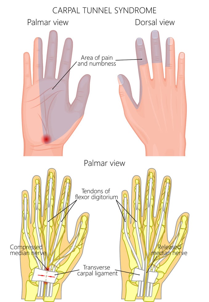 Capal Tunnel Syndrome Illustration