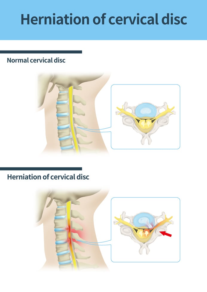 Illustration comparing a herniated disc and a normal cervical disc