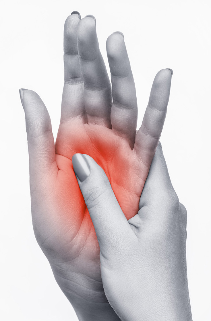 Image of a woman's hands showing pain from complex regional pain syndrome