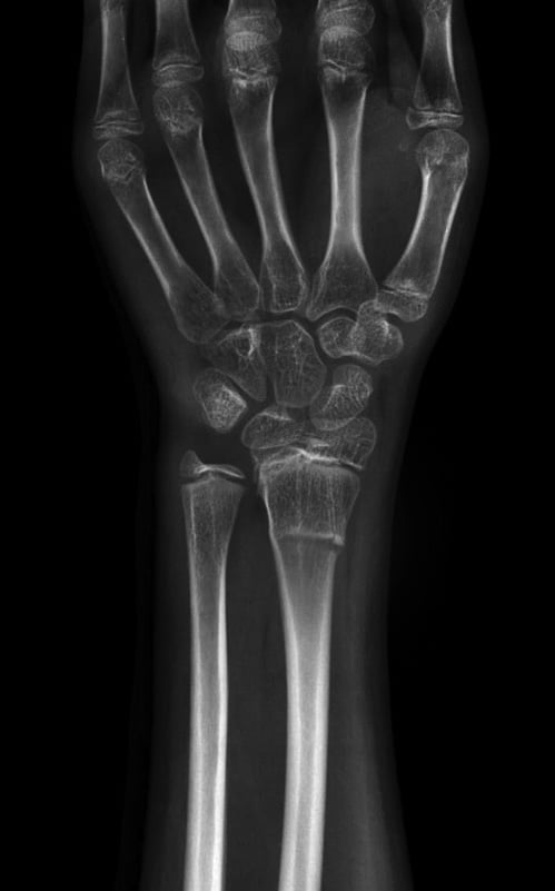 Imaging of a Distal Fracture in the Wrist