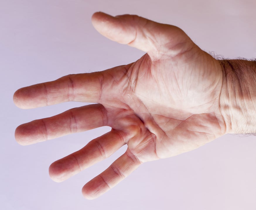 A hand with Dupuytren's Contracture