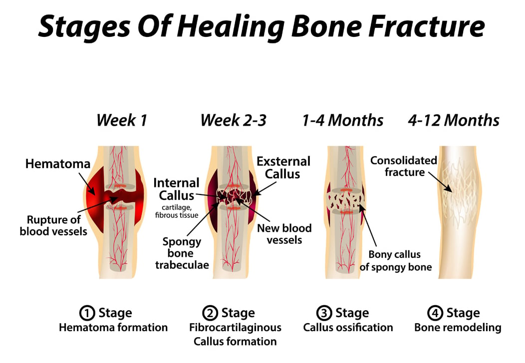 Stages of fracture healing