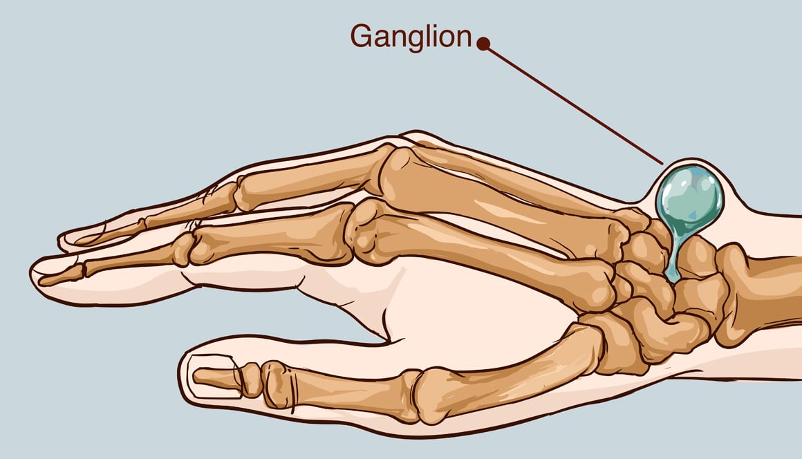 Illustration of a Ganglion Cyst