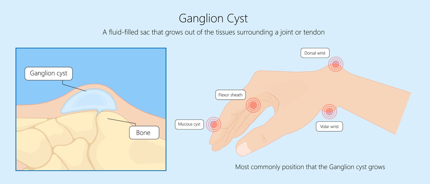 Illustration showing locations where ganglion cysts may form