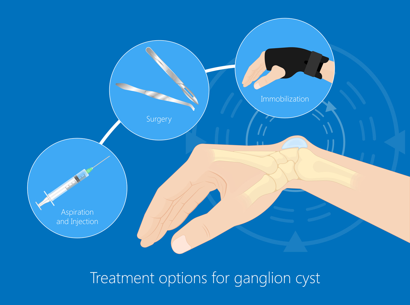 Illustration highlighting Ganglion Cyst treatment options