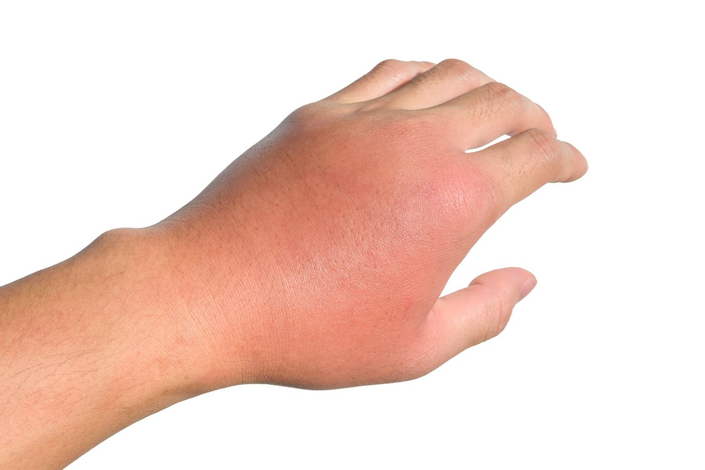 A hand with cellulitis, a skin bacterial infection.