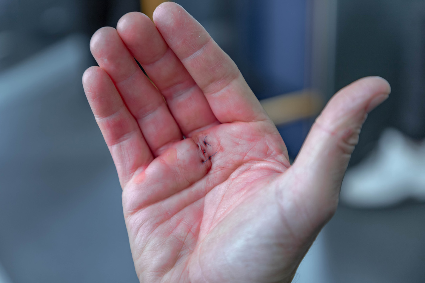 Hand of a patient recovering from minimally invasive hand surgery.