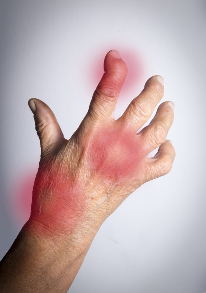 Image showing pain points and deformity from Rheumatoid Arthritis