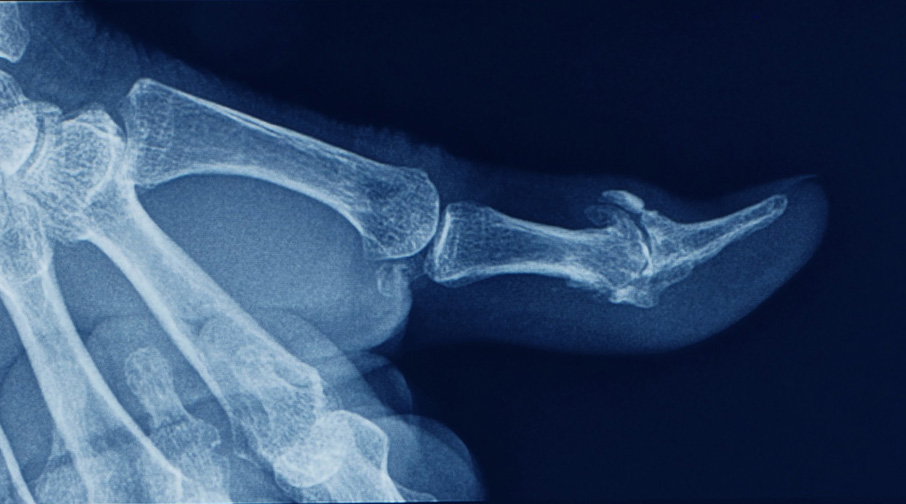 x-ray of a thumb with bone spur and mucous cyst