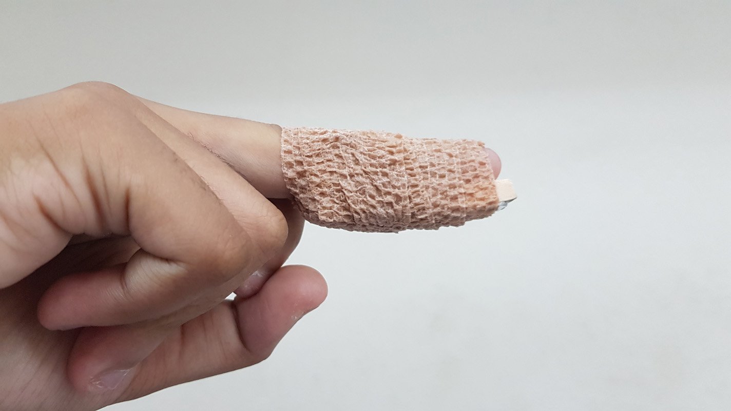 Finger with a condition called mallet finger in an alumafoam splint.