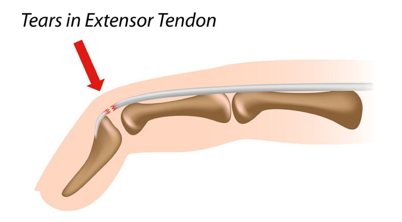 Illustration of a finger with a condition called Mallet Finger.