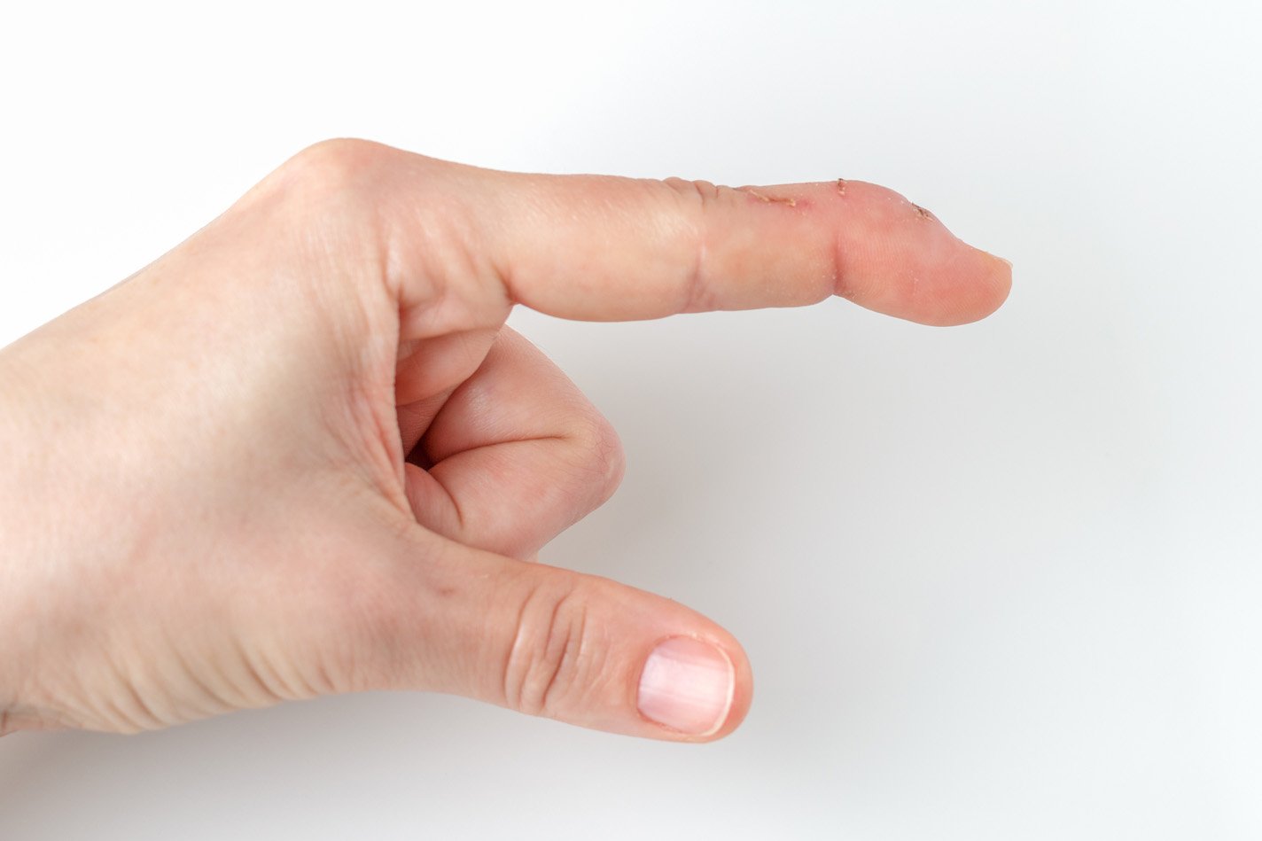 Mallet finger in the pointer finger of a person's hand