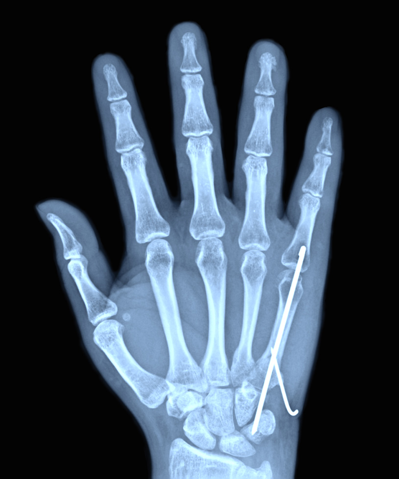 x-ray showing pinning to repair a metacarpal fracture