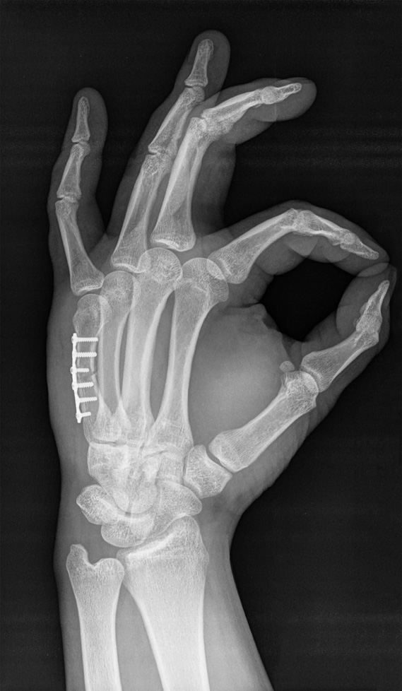 x-ray showing plating to repair a metacarpal fracture