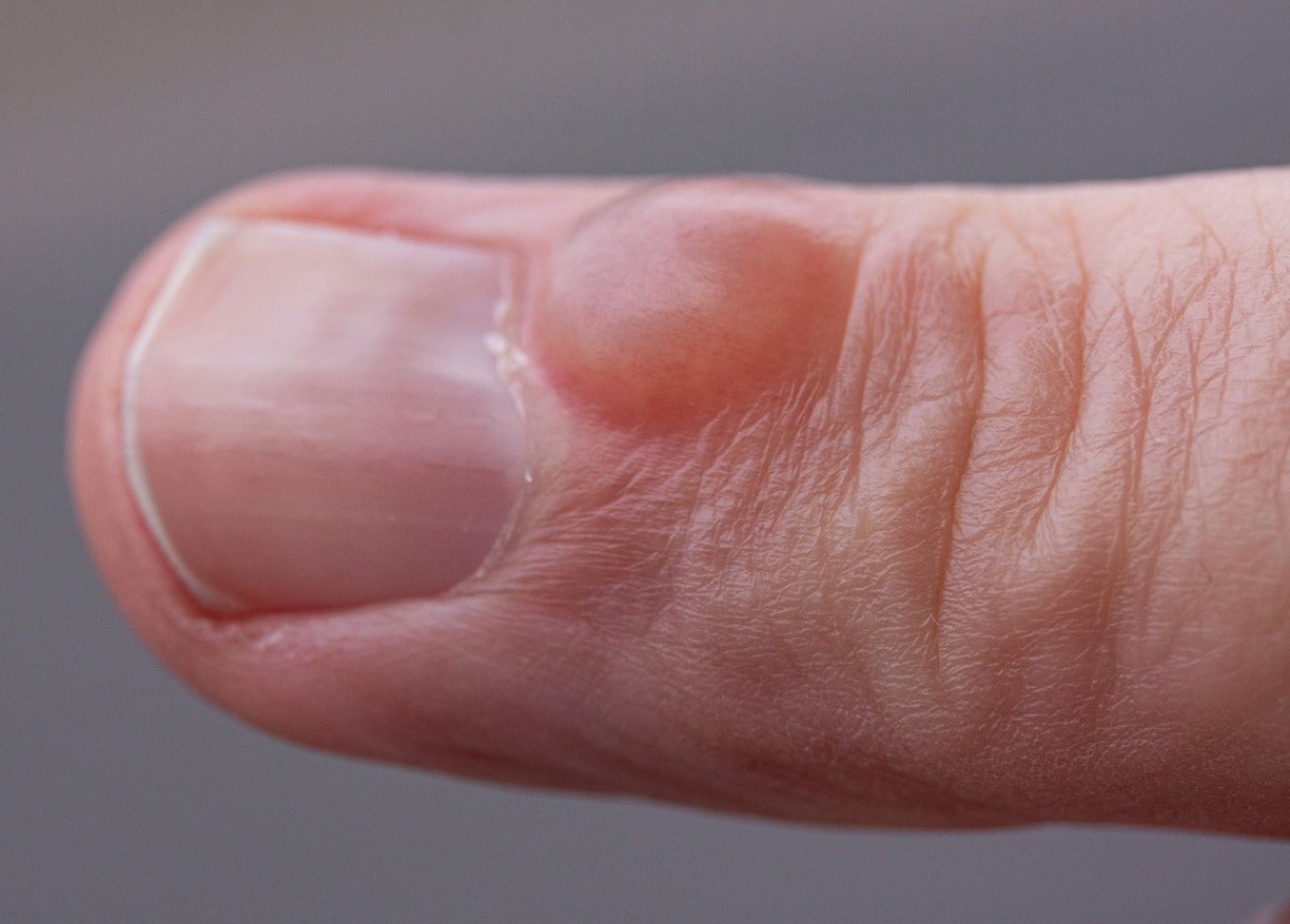 A finger with a mucous cyst causing nail deformity