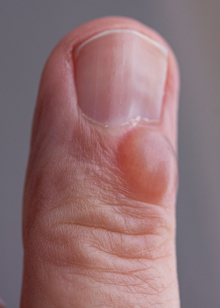 Mucous Cyst with Nail Deformity