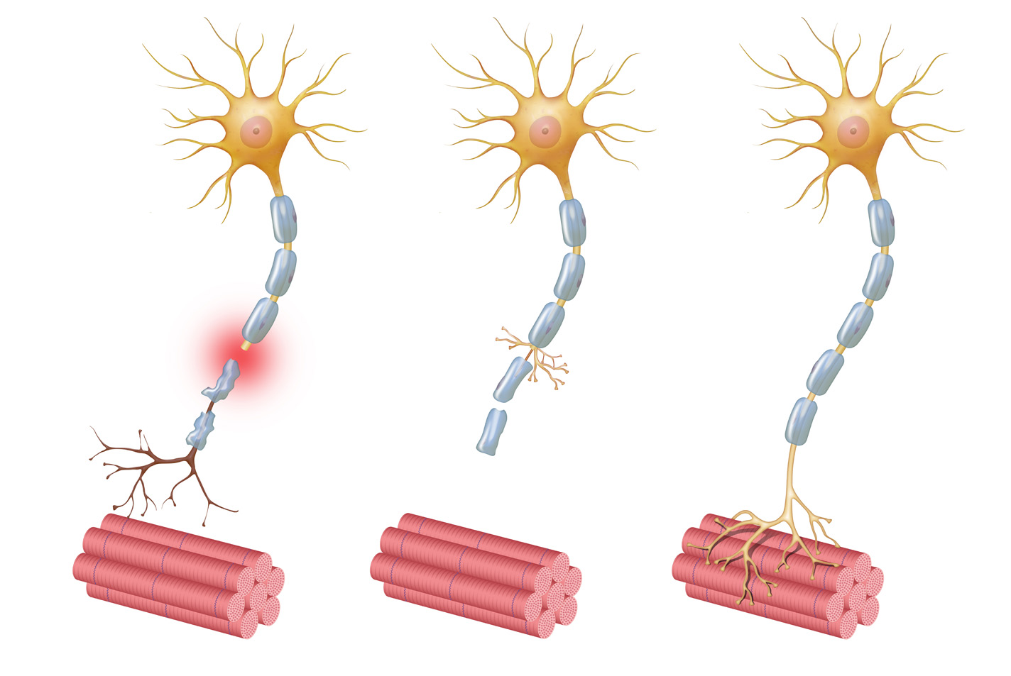 Illustration showing how nerves heal