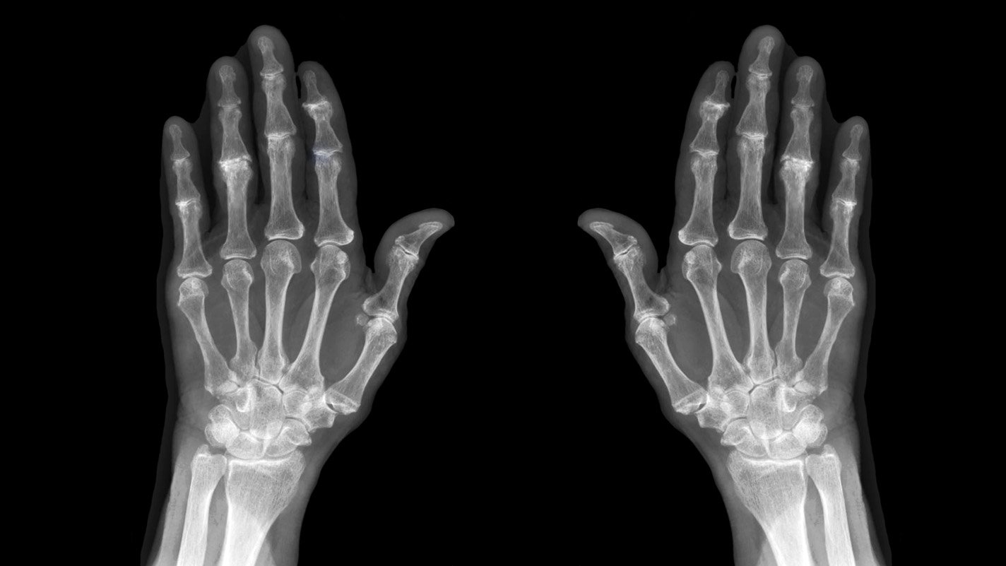 X-rays of hands with Osteoarthritis