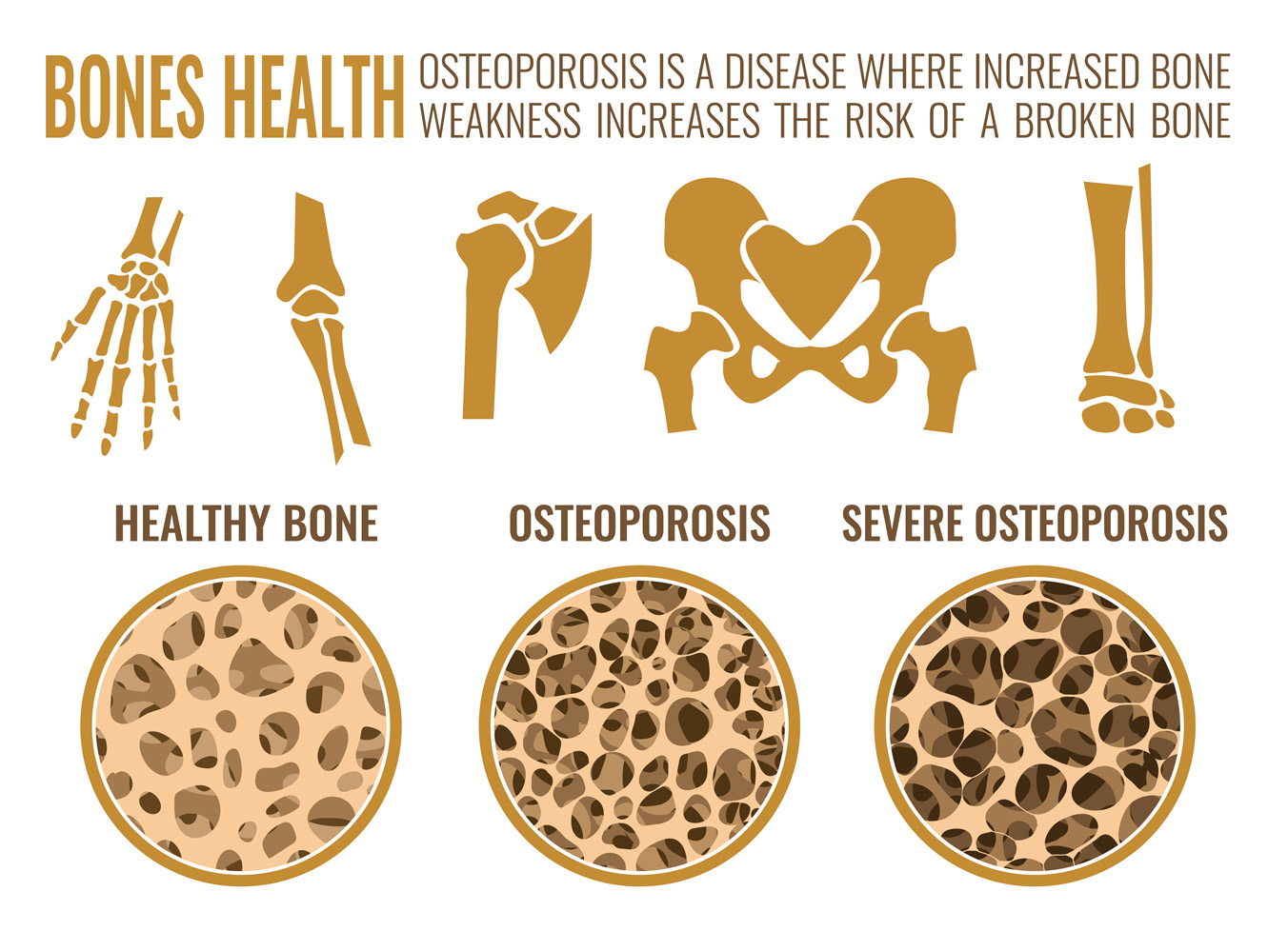 Illustration showing reduced bone density due to Osteoporosis