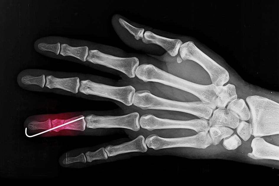 x-ray showing P2 pinning to repair a phalanx fracture