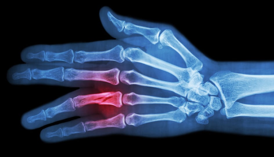 X-ray showing a Phalanx Fracture