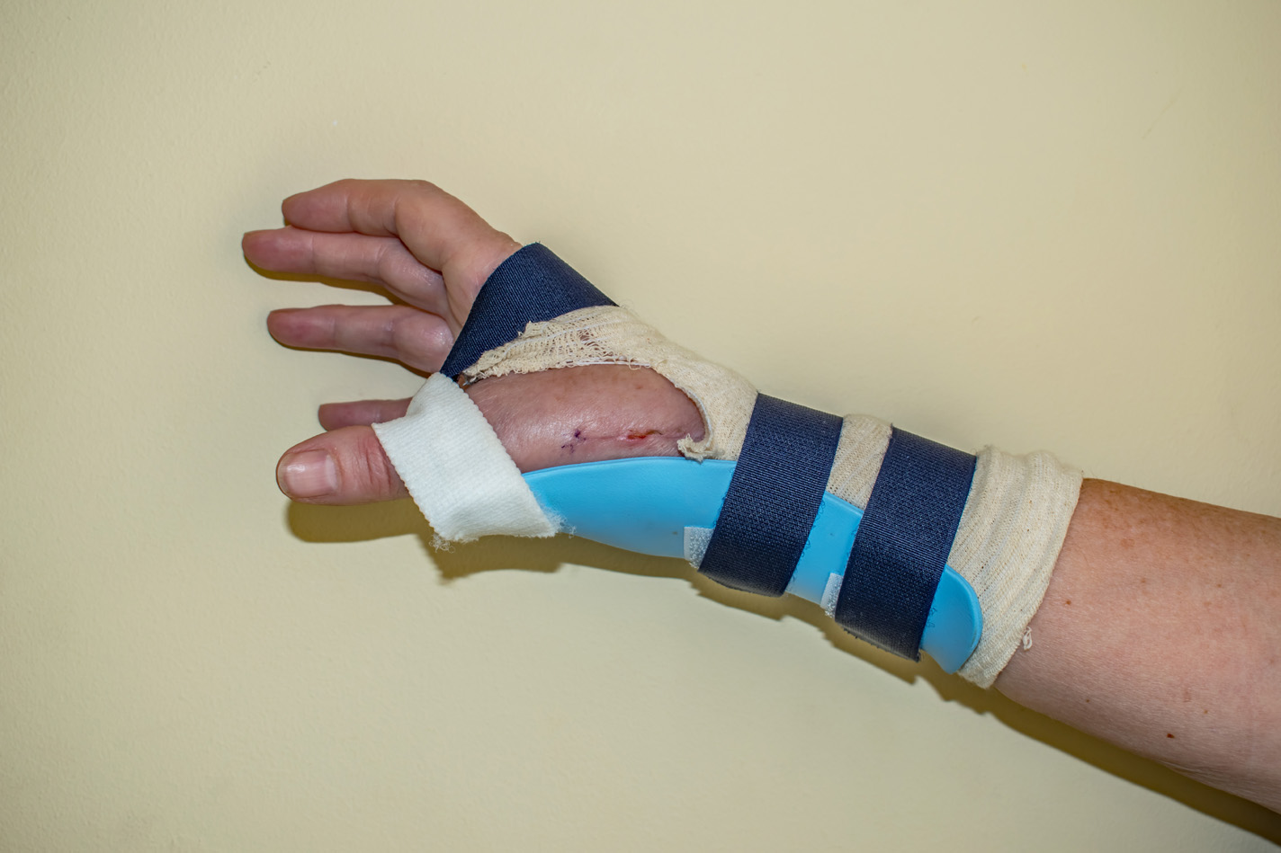 Patient's forearm in a brace after surgery