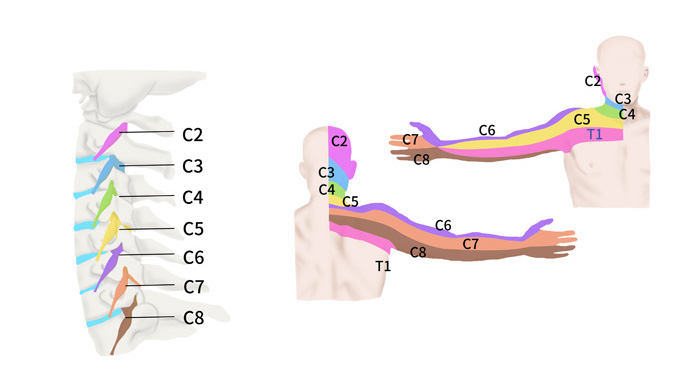 Illustration of Radiculopathy causing nerve pain