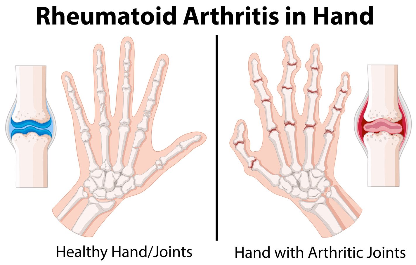 Illustration comparing healthy hands/joints versus hands with rheumatoid arthritis