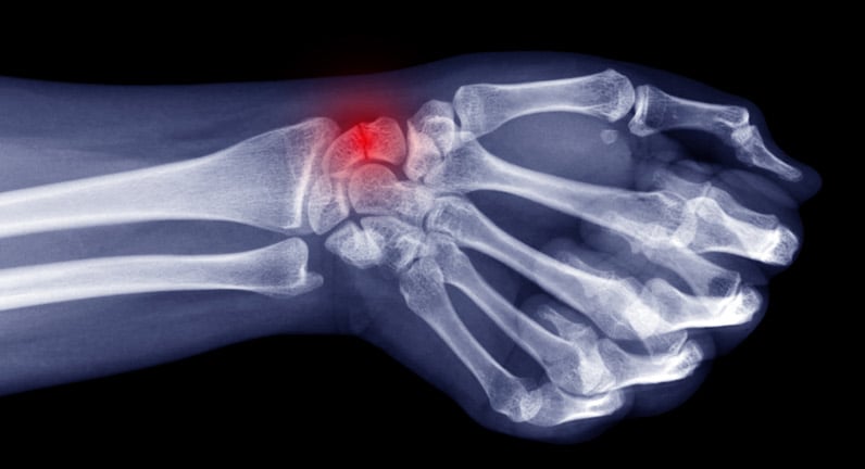 X-ray of a scaphoid fracture highlighted in red.