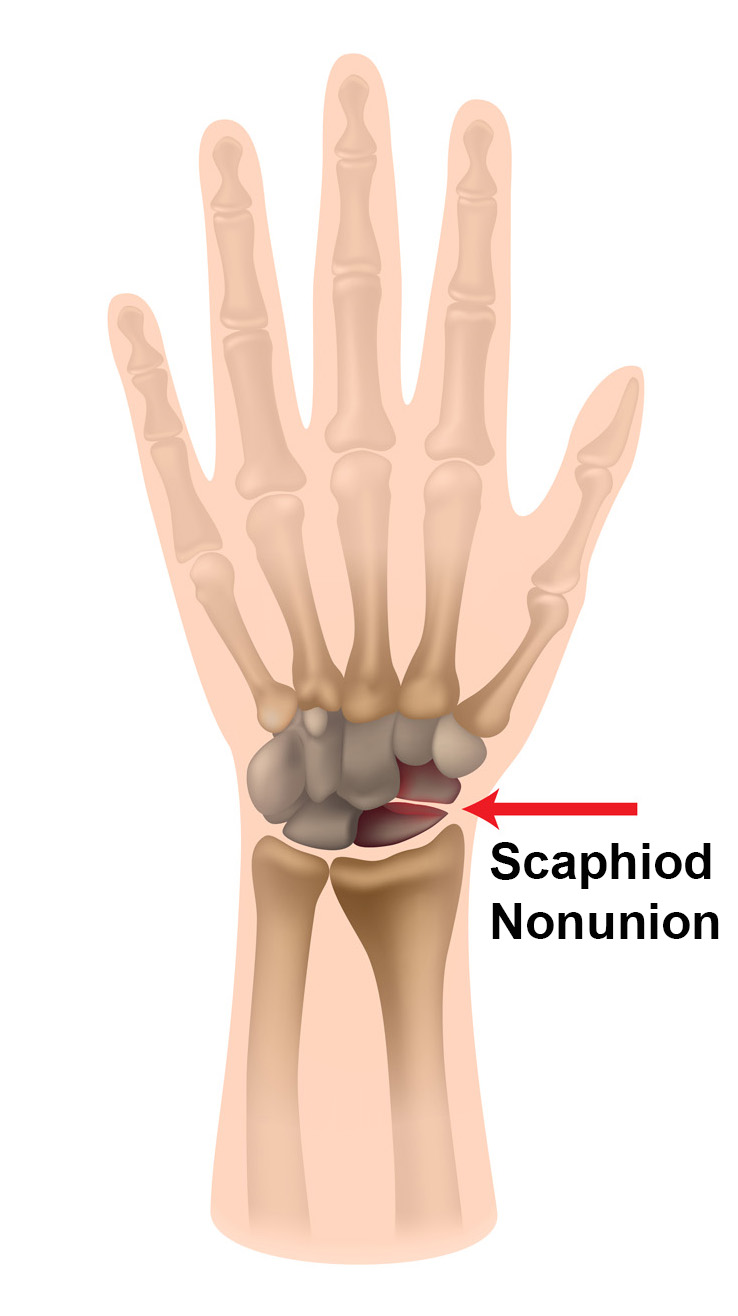 Scaphoid Nonunion