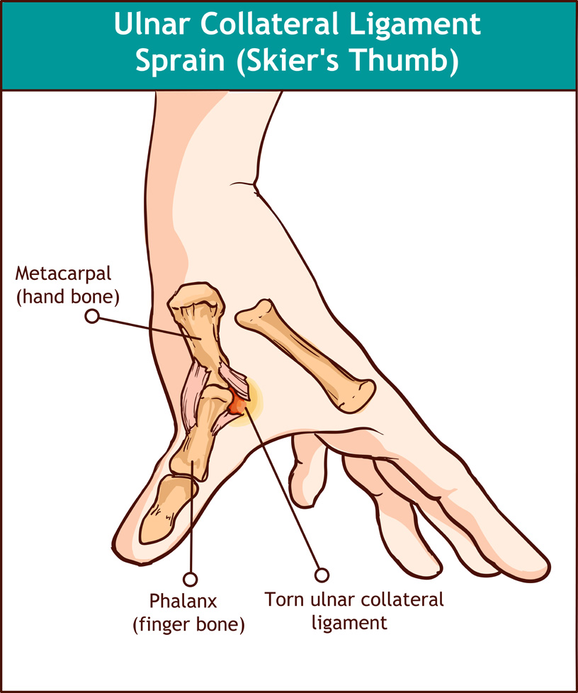 Illustration of a UCL injury called Skier's Thumb or Gamekeeper's Thumb