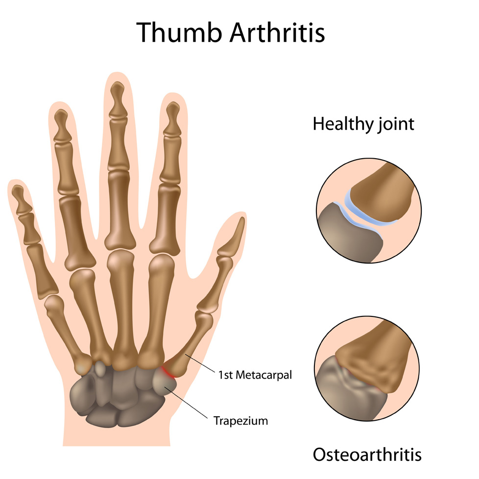 Illustration of the hand showing thumb arthritis