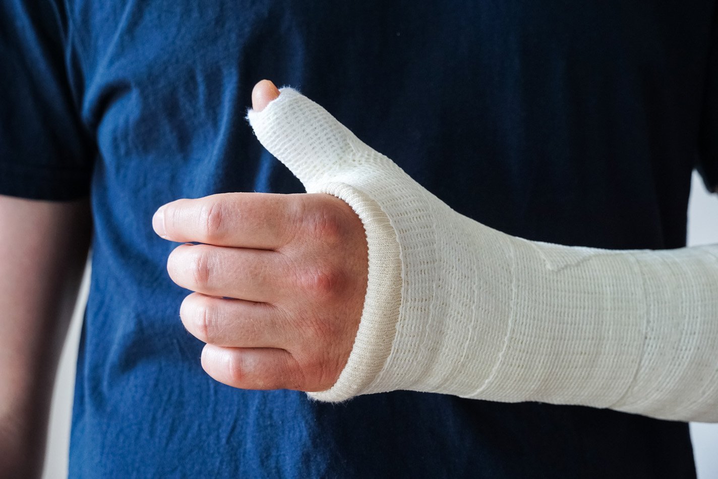 Thumb spica cast on a patient with a Scaphoid Fracture