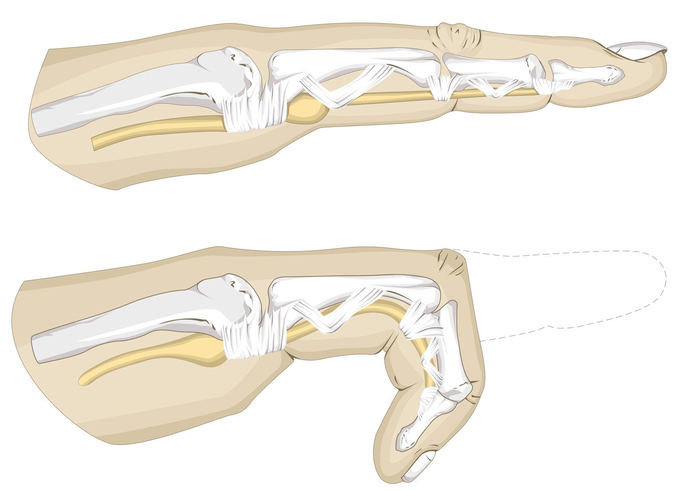 Illustration of a hand condition called trigger finger