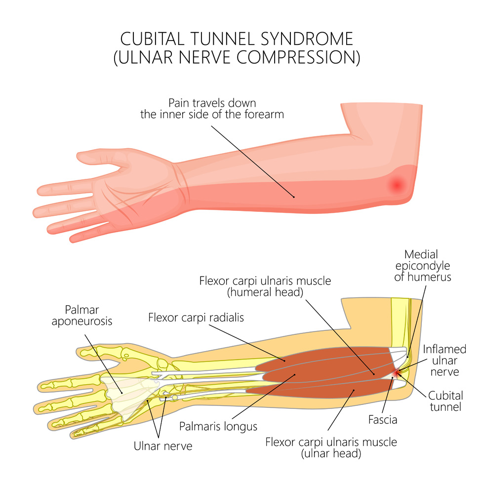 Illustration of Ulnar Nerve Compression