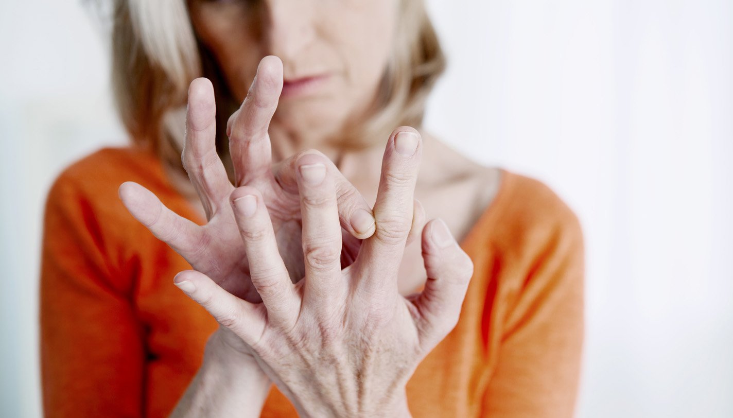 Woman with osteoarthritis shows her hands