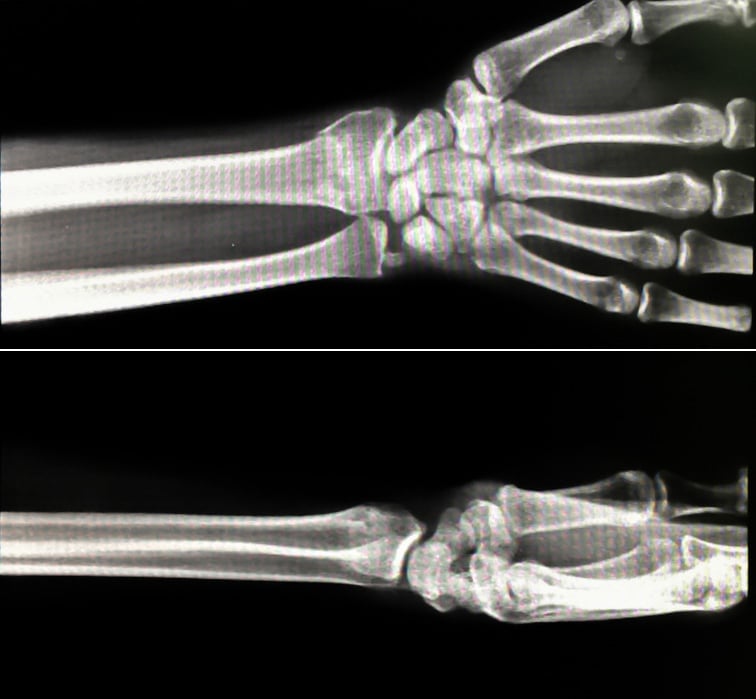 X-rays of a wrist with a wrist fracture malunion